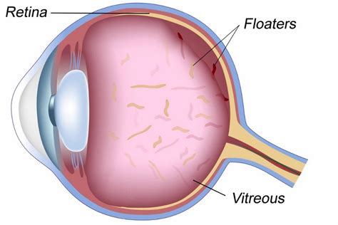 Different Types of Eye Floaters - What Causes Them? - The Eye News