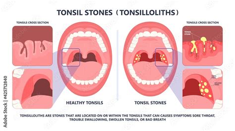 Tonsil Stones crypts viral virus gland strep throat sore enlarged lymph ...