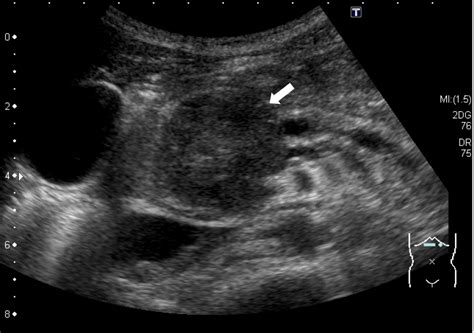 Solid pseudopapillary neoplasm of the pancreas in a young male with main pancreatic duct ...