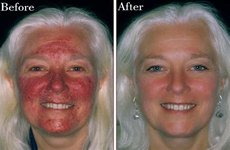 Natural Treatment For Healling Rosacea - NikiHow