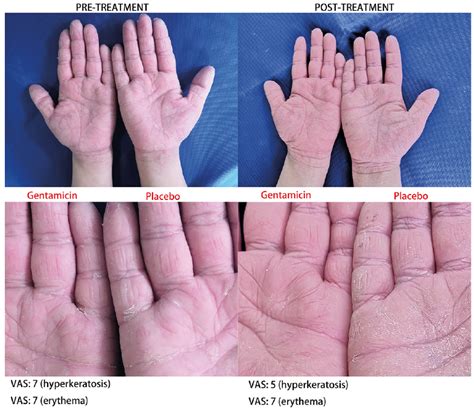 Effect of Gentamicin Ointment in Patients with Nagashima-type Palmoplantar Keratosis: A Double ...