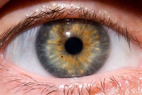 Signs Of Disease In The Eyes - Business Insider