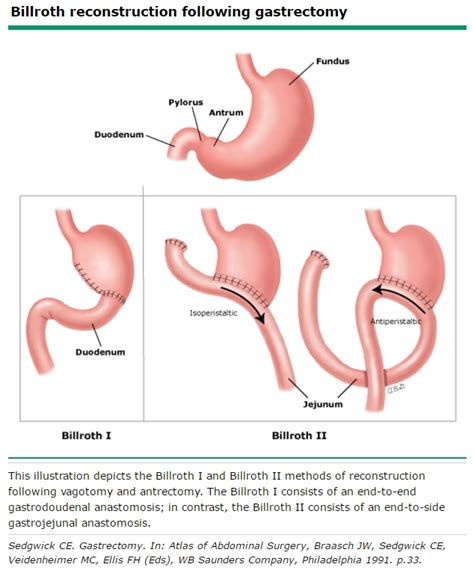 Billroth Surgery