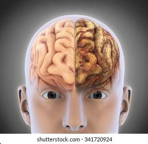 2 Brain Stroke Comparision Bilder, Stockfotos und Vektorgrafiken ...