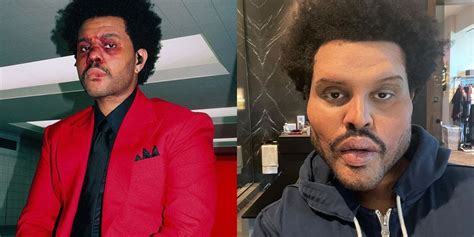 The Weeknd Finally Revealed What Is Going On With His Face - Narcity