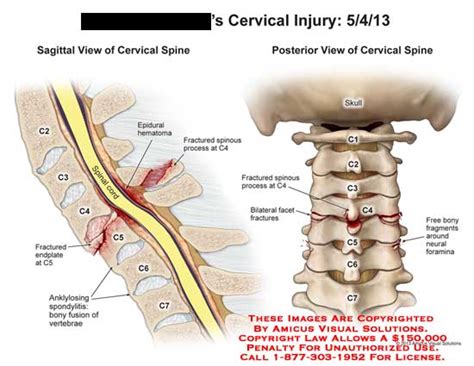 Spinal Cord Injury