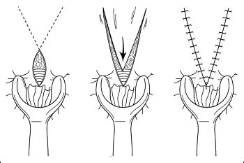 Anal stenosis - The American Journal of Surgery