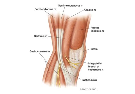 Saphenous nerve neuroma after total knee arthroplasty - Mayo Clinic