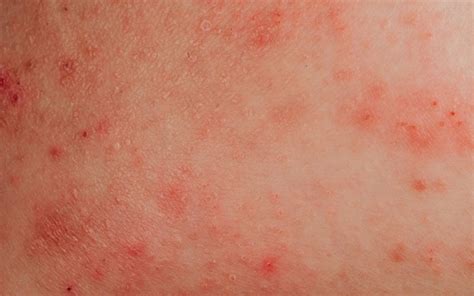 What Triggers Eczema and How To Avoid It?