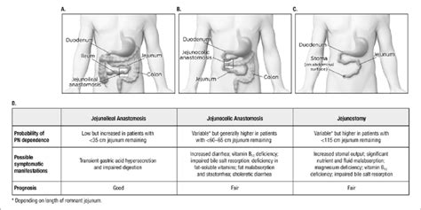 Types of intestinal resections: (A) jejunoileal anastomosis, (B ...