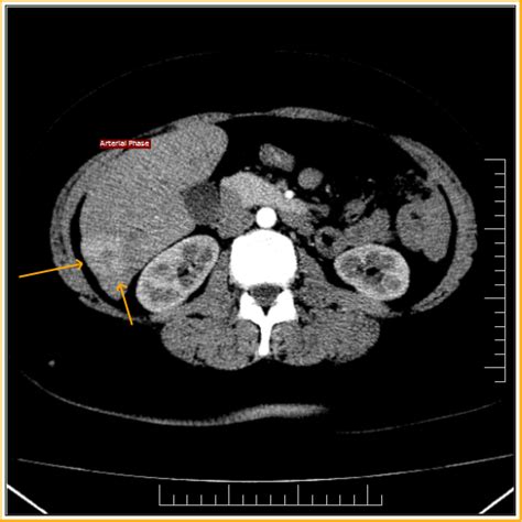 Focal Nodular Hyperplasia: CT - Sumer's Radiology Blog