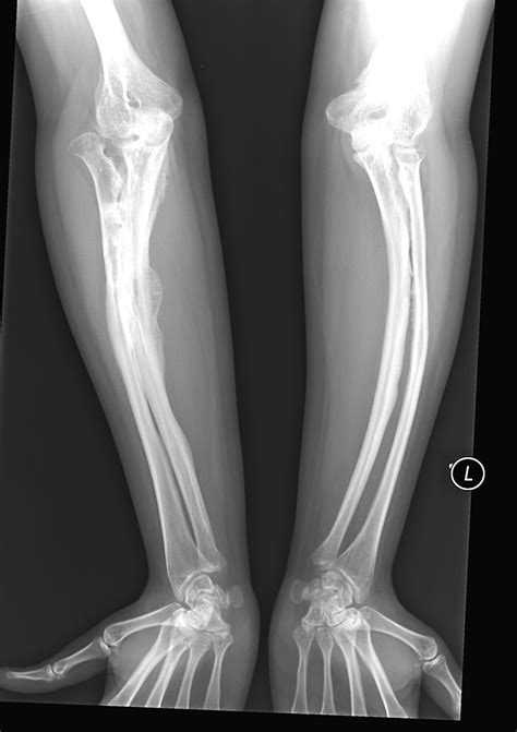 Osteogenesis imperfecta (OI) | Britannica