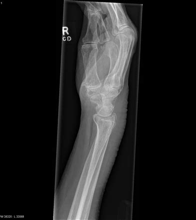 Distal radial fracture, triscaphe and first carpometacarpal joint osteoarthritis | Image ...