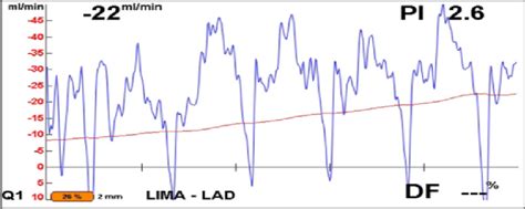 -Flowmetry of the LIMA-LAD graft at the end of the surgical procedure. | Download Scientific Diagram