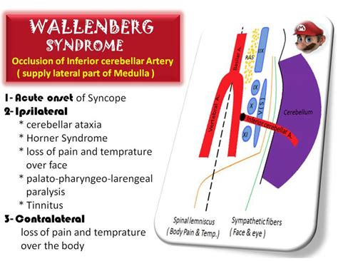 wallenberg syndrome - Google Search | Nurse | Pinterest