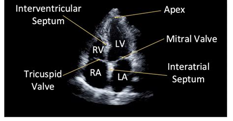 Echocardiogram Anatomy