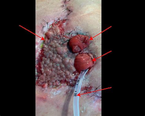 What is an Enterocutaneous Fistula and Enteroatmospheric Fistula?