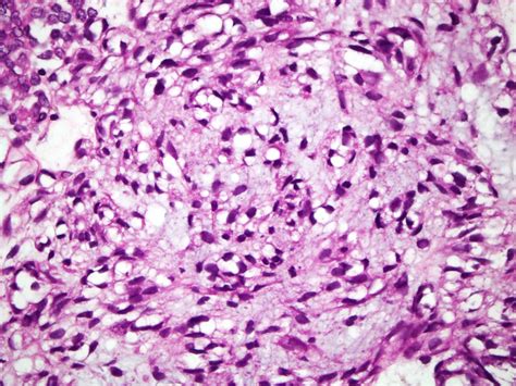 Stomach - Gastrointestinal stromal tumor (GIST)