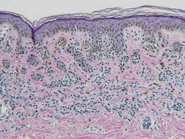 Speckled Lentiginous Nevus Workup: Histologic Findings