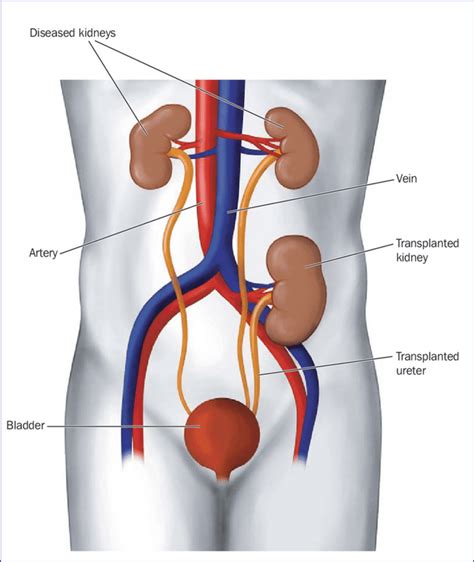 New Kidneys are located really high up. Interestingly discovered that transplanted kidneys now ...