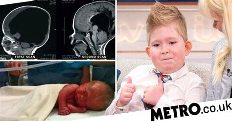 Boy born without a brain defies odds and is now learning to walk | Metro News