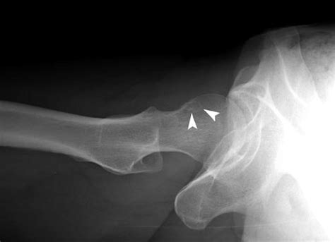 14. A 26-year-old woman with hip pain and synovial herniation pit ...