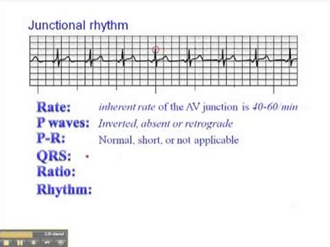 ECG: Junctional Rhythm - YouTube