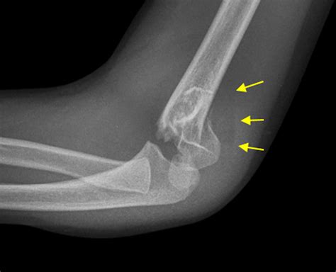 Cureus | Role of the Posterior Fat Pad Sign in Treating Displaced Extension Type Supracondylar ...