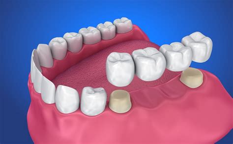 Dental Bridges: A Great Option for Replacing Missing Teeth | Saby Dental