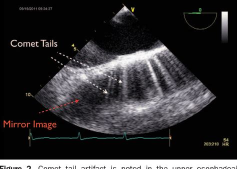 Figure 3 from Imaging artifacts during transesophageal echocardiography. | Semantic Scholar