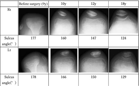 Figure 1 from Surgical Treatment of Chondrodysplasia Punctata Tibial-Metacarpal Type Until ...