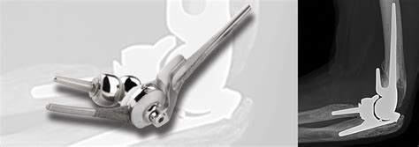 LATITUDE EV™ Total Elbow Arthroplasty - Wright Medical Group