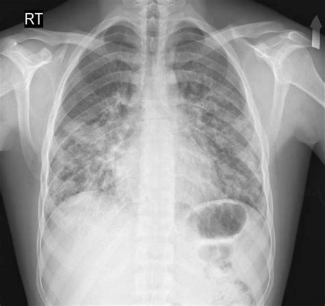 Eosinophilic pneumonia chest x ray - wikidoc