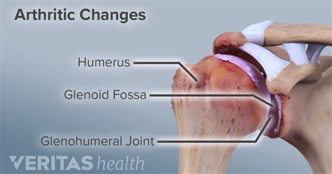 What Is Shoulder Osteoarthritis (Glenohumeral Arthritis)?