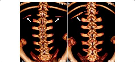 Transitional vertebrae with characteristics of both the cranially and... | Download Scientific ...