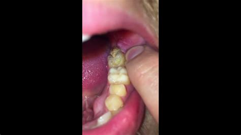 Infection after wisdom teeth removal - YouTube