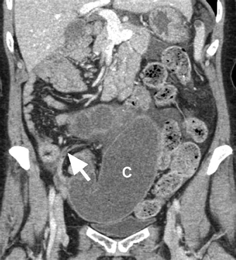 67-year-old woman with right lower quadrant pain and cecal volvulus ...