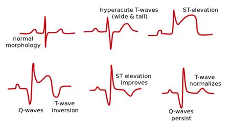 emDOCs.net – Emergency Medicine EducationECG Pointers: Post Myocardial ...