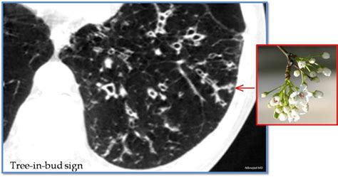 Tree-in-bud sign | Radiology, Signs, Pathology