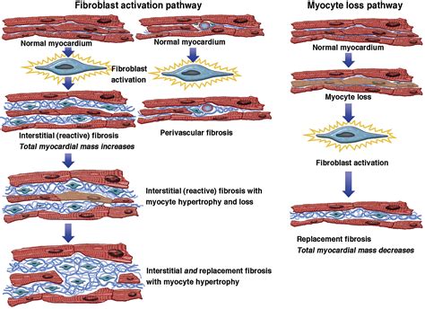 Myocardial Scar and Fibrosis - Heart Failure Clinics