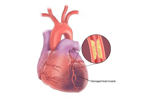 Coronary Artery Disease (Heart Attack) Symptoms | UPMC