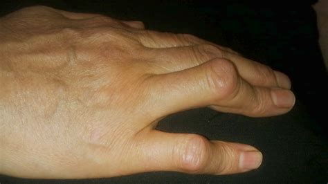 Rheumatoid Arthritis Hand Deformities: What to Do