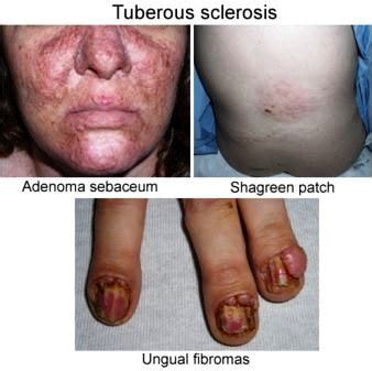 Tuberous Sclerosis Pictures, What is, Symptoms, Treatment