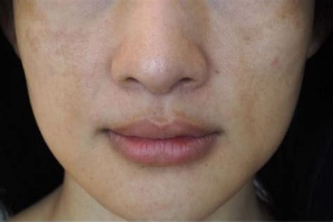 Does Glycolic Acid Help With Hyperpigmentation? – Open Formula