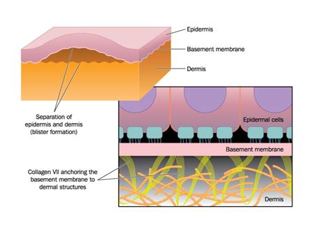 Causes, Treatment , and Prevention of Blisters - Caruso Foot and Ankle