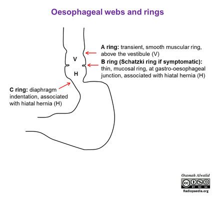 Lower esophageal ring - Pictures