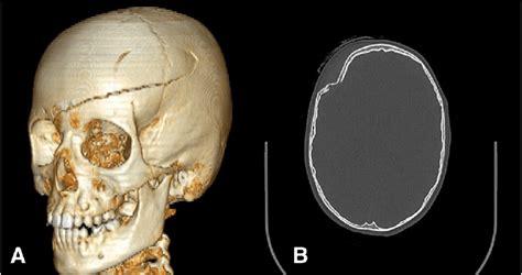 Compound Skull Fracture