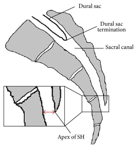 Caudal Anesthesia in Children - OpenAnesthesia