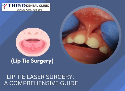 Lip Tie Laser Surgery: A Comprehensive Guide