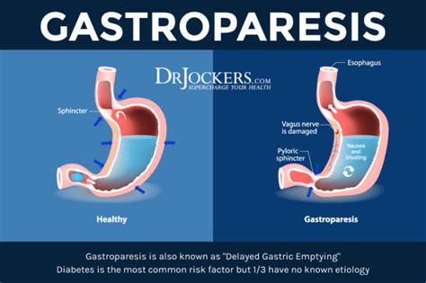 Gastroparesis: Symptoms, Causes and Natural Support Strategies